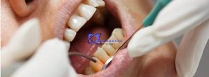 خطرات دندانپزشکی لیزری